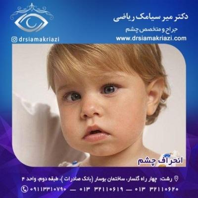 انحراف چشم