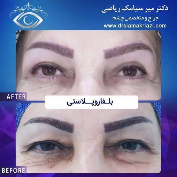 عکس قبل و بعد جراحی زیبایی پلک