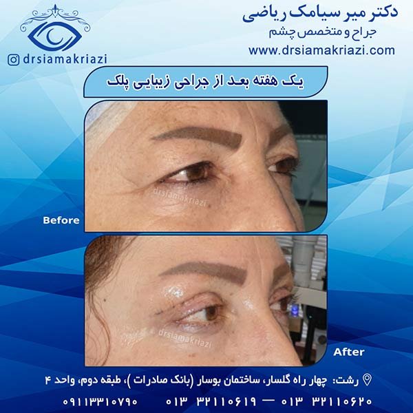 عکس قبل و بعد جراحی زیبایی پلک