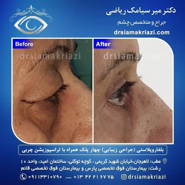 عکس قبل و بعد جراحی زیبایی پلک